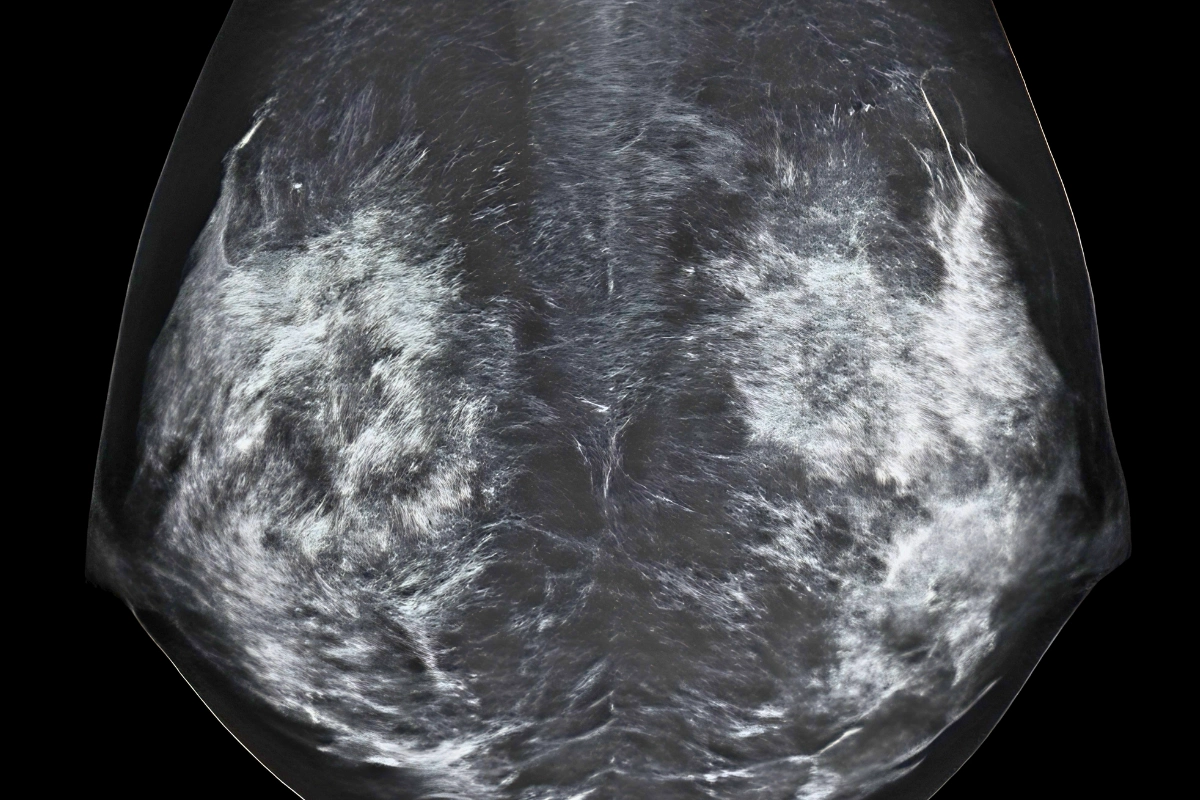 How Breast Cancer Screening Works in Japan for LGBTQ+ People 15 A mammogram showing X-ray images of breast tissue.
